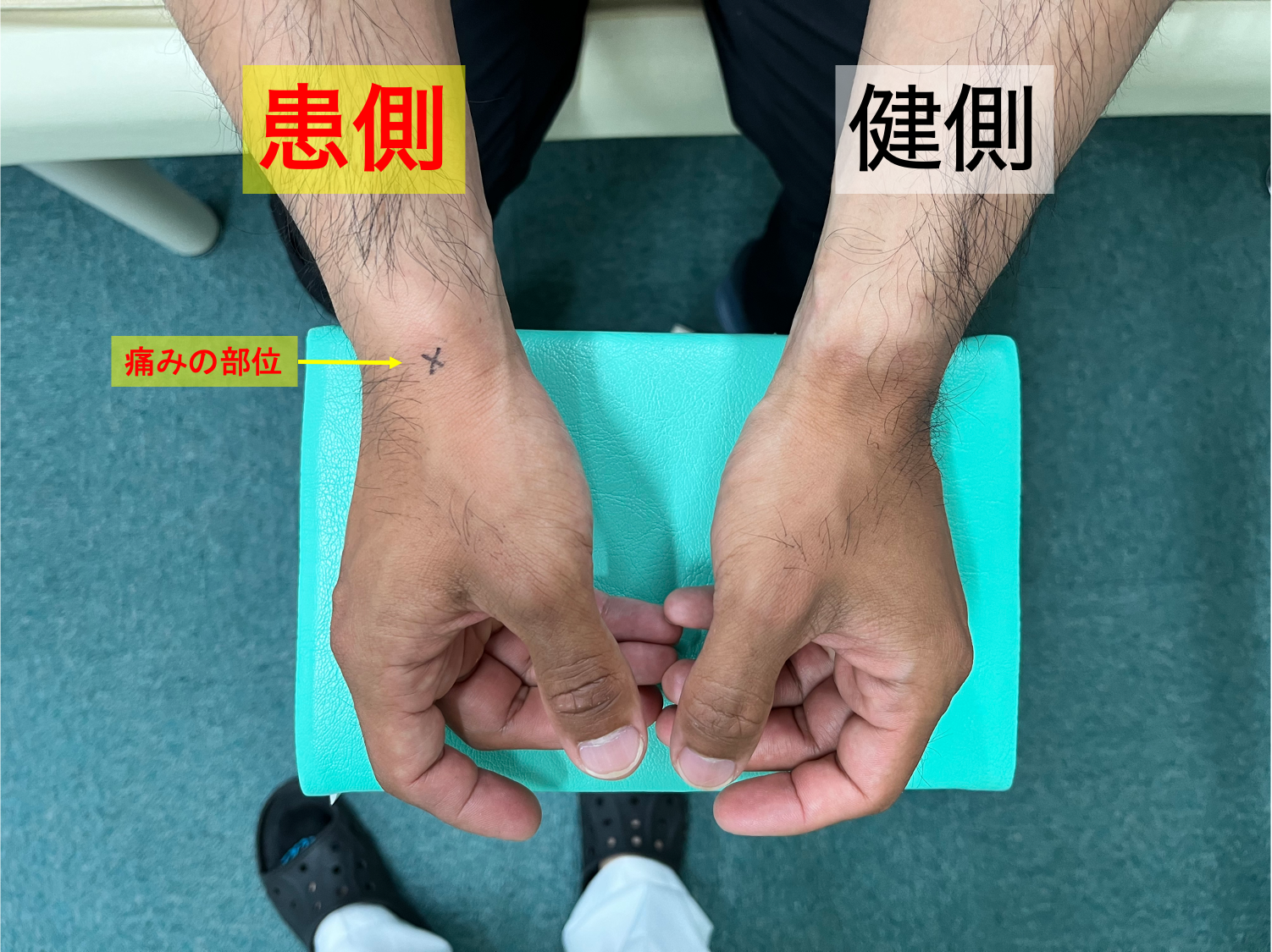 手首の腱鞘炎で痛みが出現する部位を示す画像写真