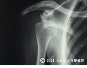 肩関節脱臼のレントゲン画像