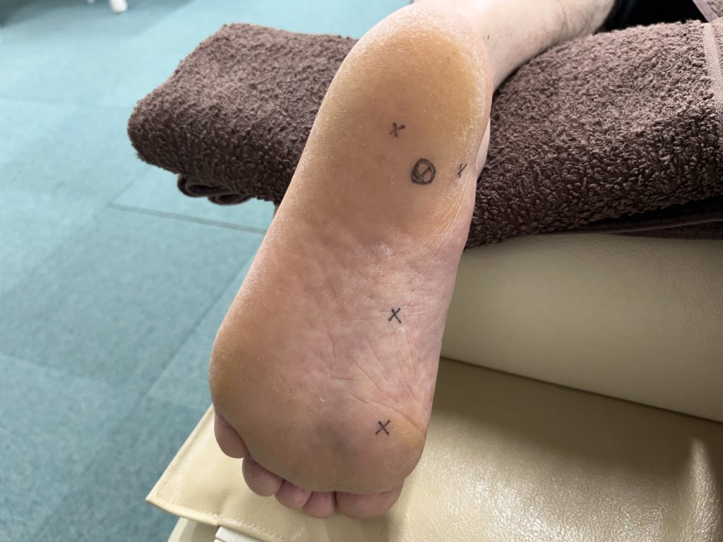 踵の角化が著しい足底腱膜炎の方の足裏（圧力波療法のためにマーキングを施している）の写真