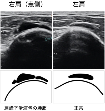 肩峰下滑液包炎のエコー画像｜右肩（患側）と左肩の比較