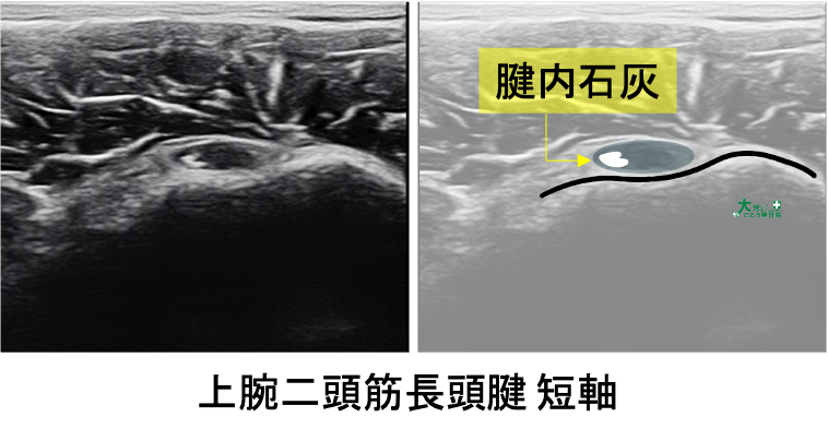 上腕二頭筋長頭腱の短軸エコー像｜結節間溝部の上腕二頭筋長頭腱々鞘内に石灰を観察できる