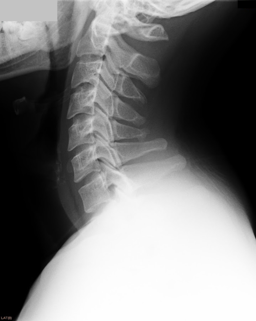 頚椎の側面レントゲン画像