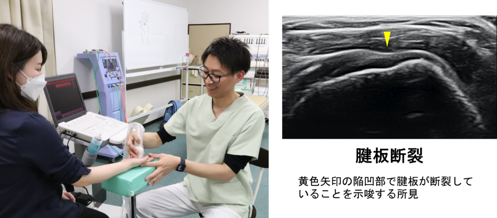 左写真はエコー観察をする施術者と女性クライアント、右図は腱板断裂のエコー画像