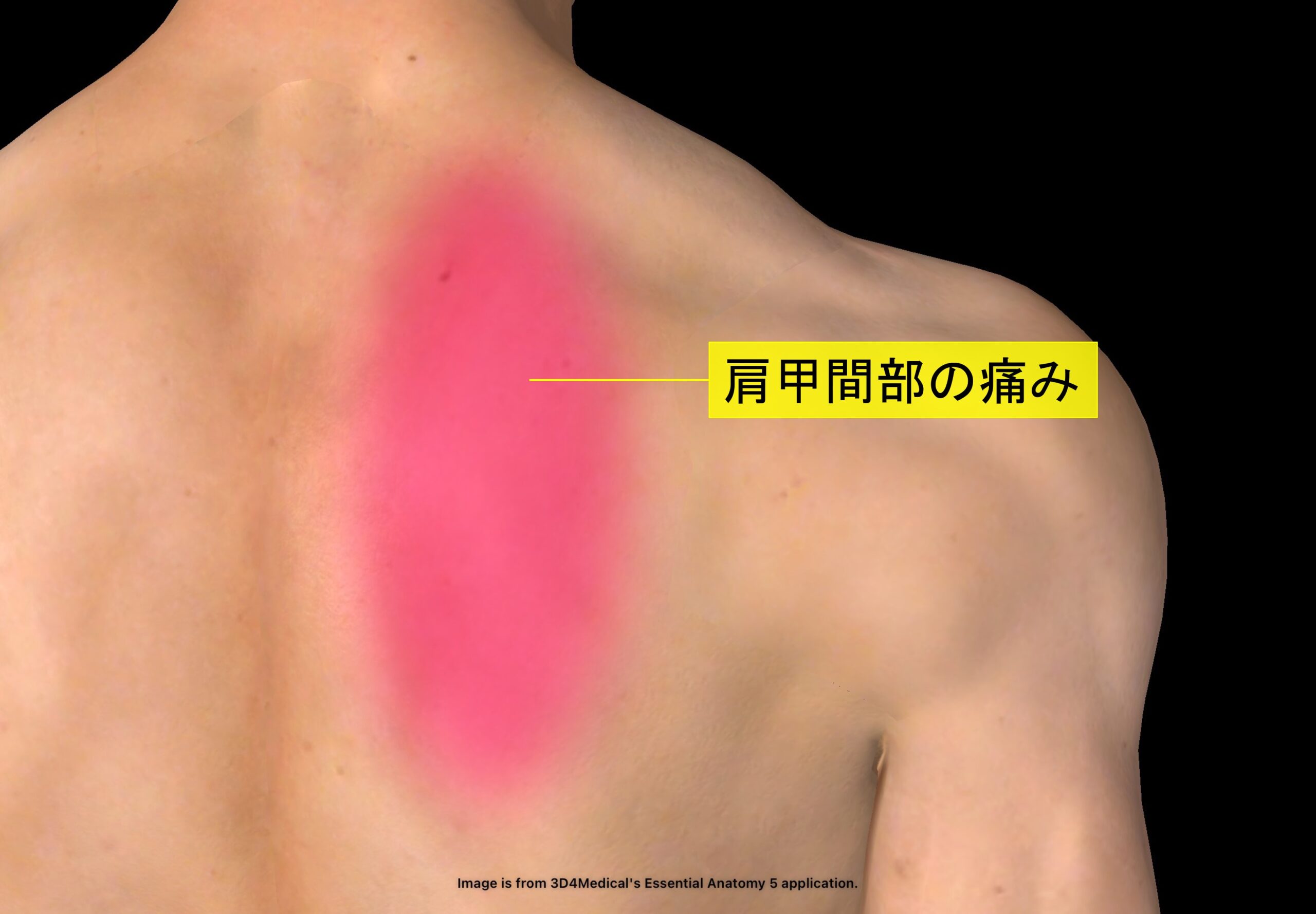 肩甲間部の痛み