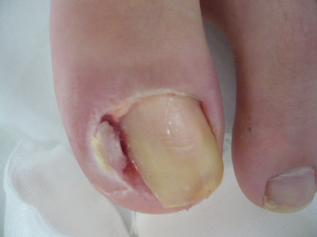 爪周囲炎の症例写真
