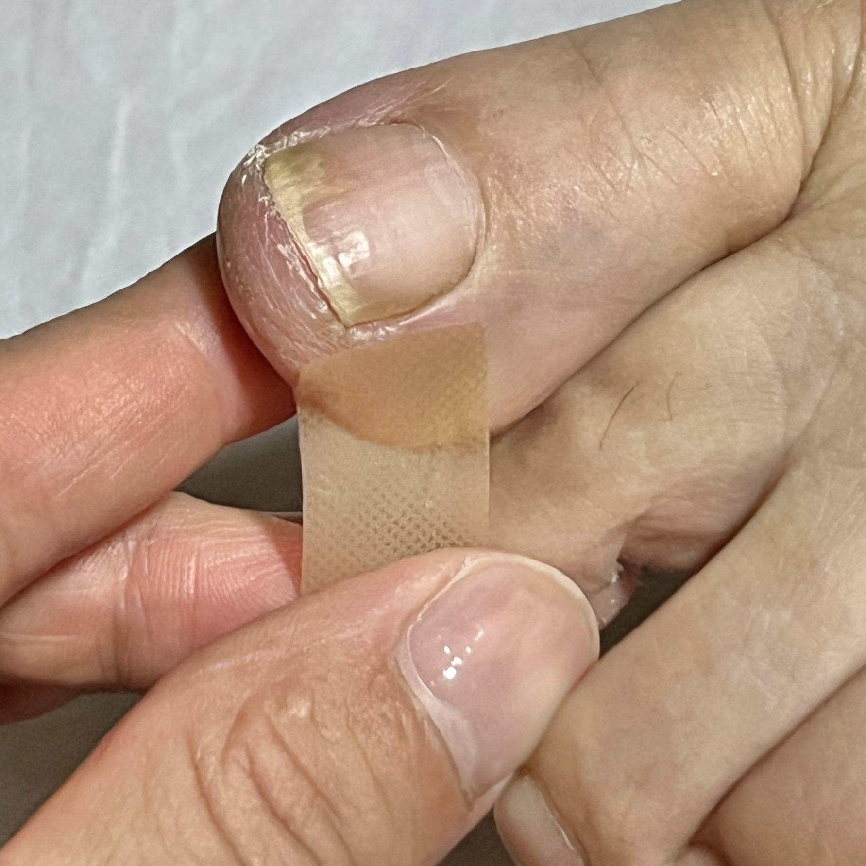 巻き爪の応急処置（スキンダウン）の一本目のテープを貼付している画像