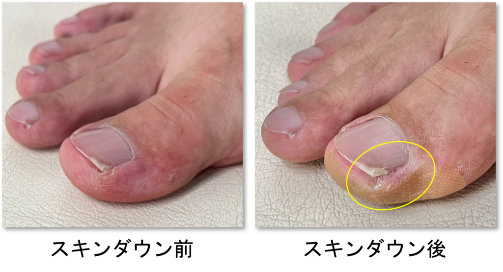 スキンダウン前・後の比較画像｜スキンダウン後は側爪郭（爪の内側の皮膚隆起）が押し下げられている