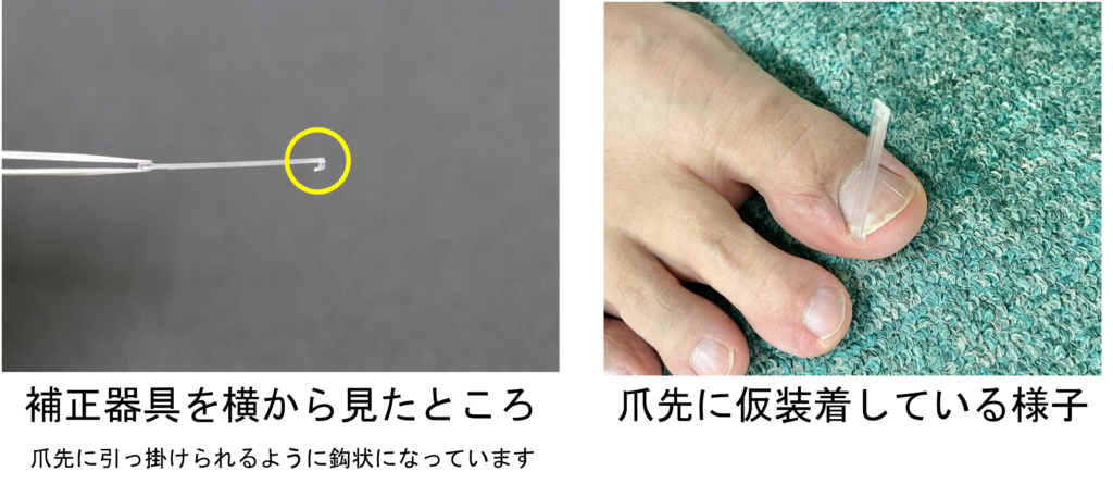 ペディグラスの巻き爪補正器具を爪先に仮装着している様子