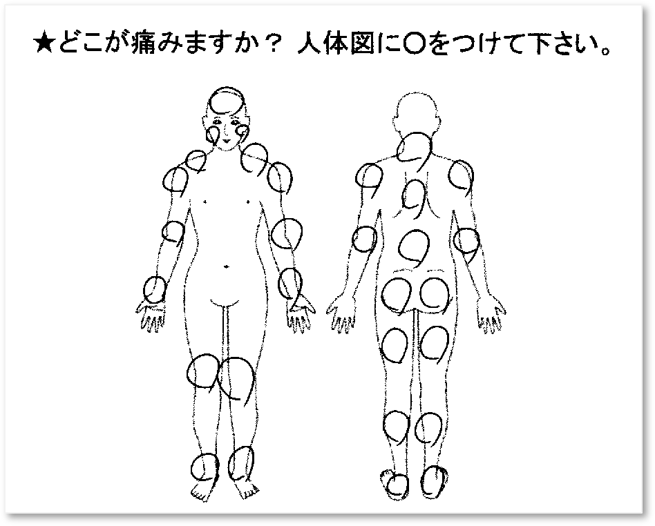 「どこが痛みますか？人体図に〇をつけて下さい。」と書かれた問診表の人体図に、複数の〇がつけられている画像