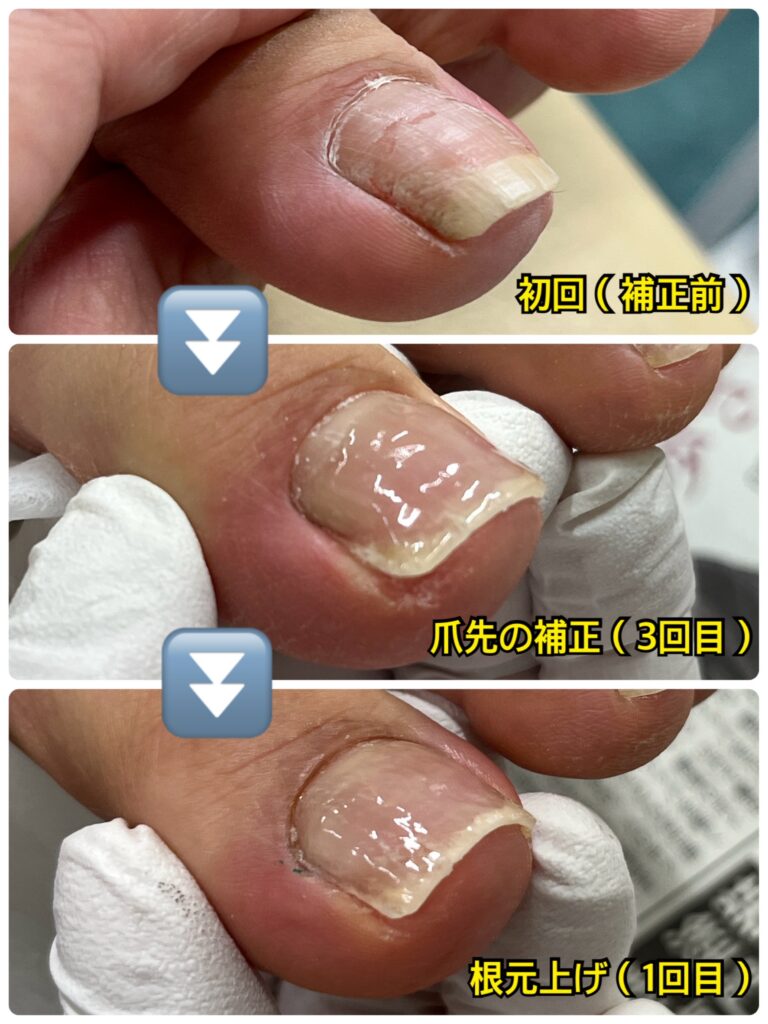 巻き爪補正を継続することで、巻き込みが改善され、爪の幅が広がっている症例写真