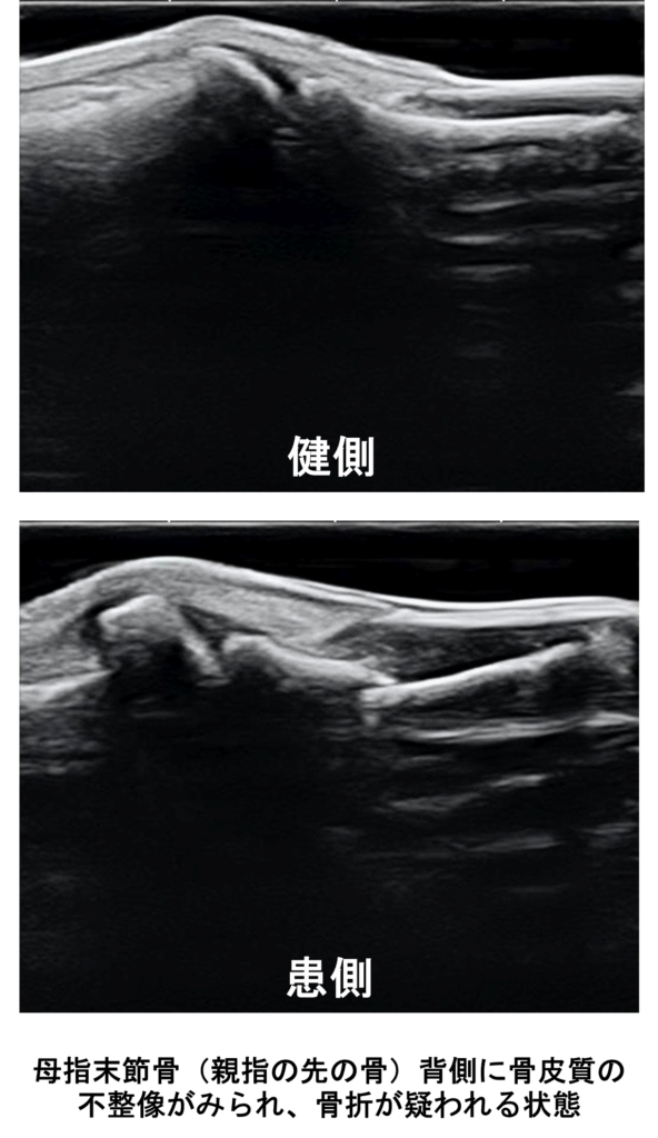 母指末節骨骨折のエコー写真|健側との比較画像