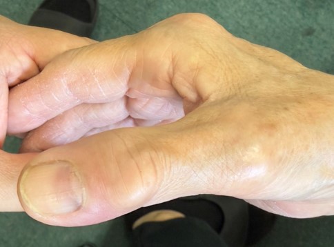母指末節骨骨折の外見写真|背側から観察すると、爪根部に爪下血腫の名残を認める