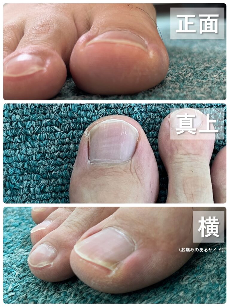 母趾の爪の状態がわかるように、正面・真上・横の3方向から撮った写真