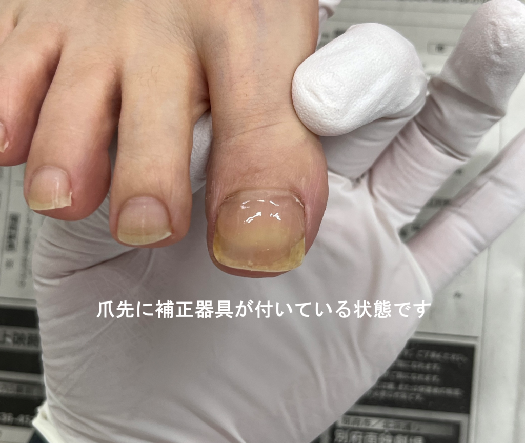 爪先に補正器具を装着した状態の写真（付いているかわからないくらい目立ちにくいです）