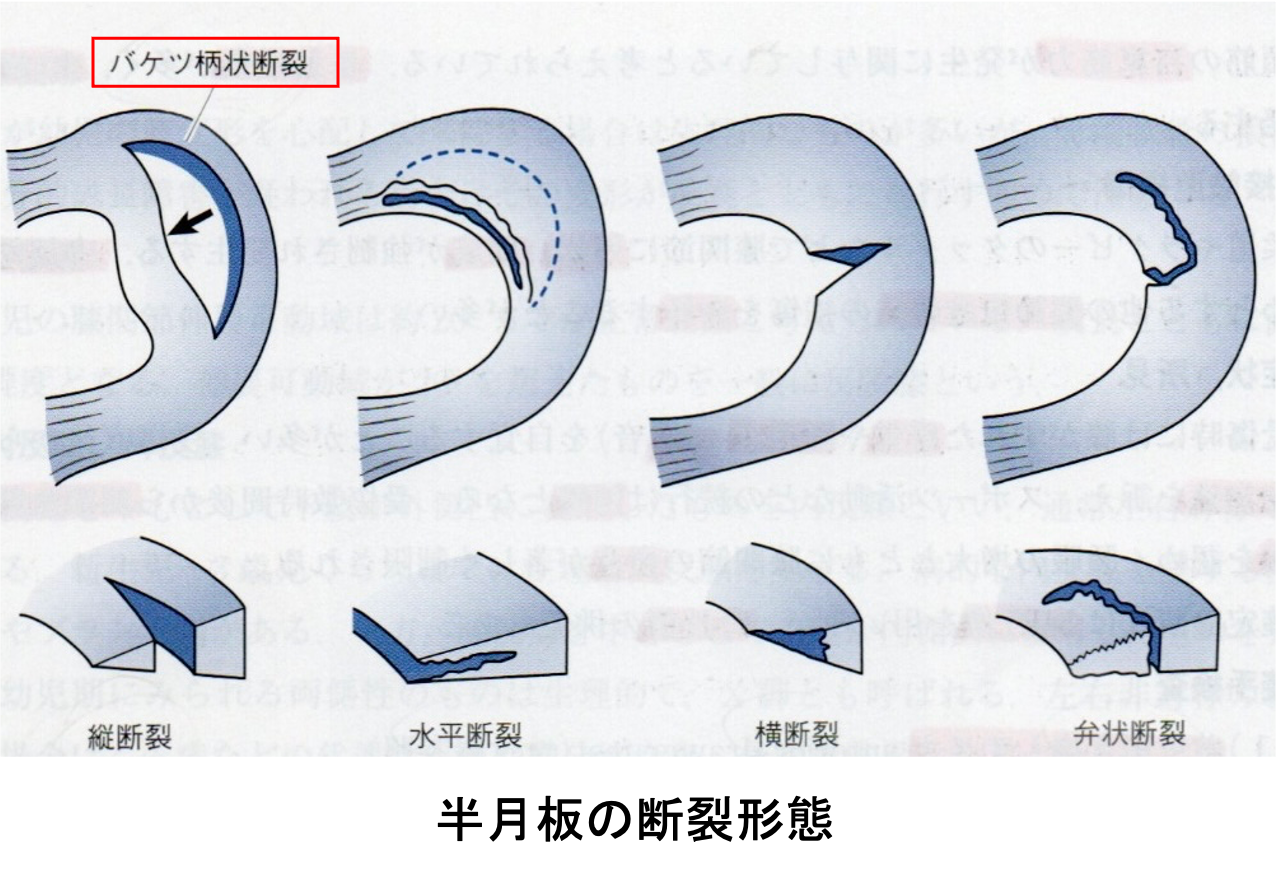 半月板の断裂形態｜出典：『柔道整復学・理論編 改訂第7版』南江堂，p.387 図3−３−5