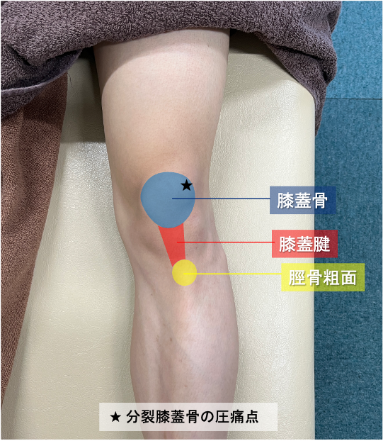 有痛性分裂膝蓋骨(Ⅲ型)の圧痛点を★で示す