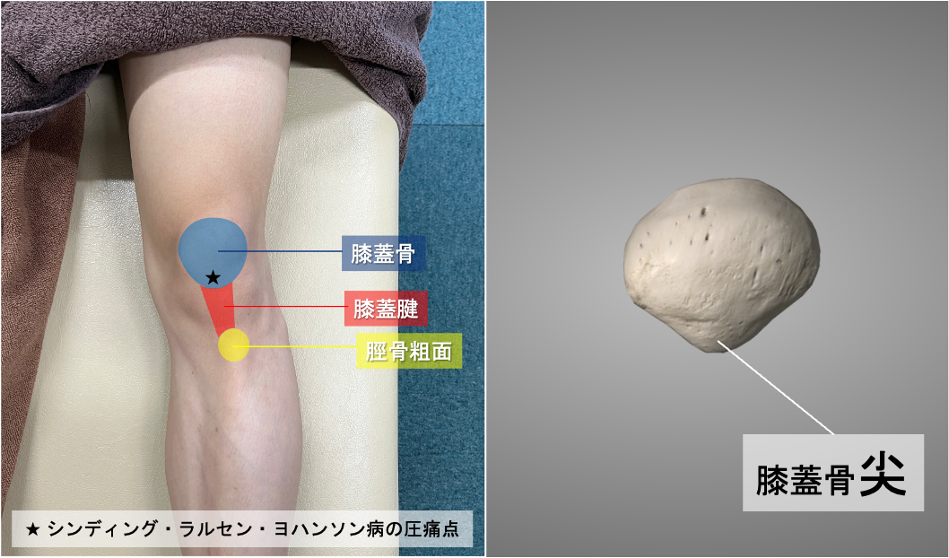 シンディング・ラルセン・ヨハンソン病の圧痛点を★で示す|膝蓋骨の解剖|出典:Image courtesy of Essential Anatomy 5 (@3D4Medical)