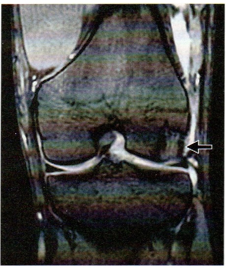 骨挫傷(bone bruise)のMRI